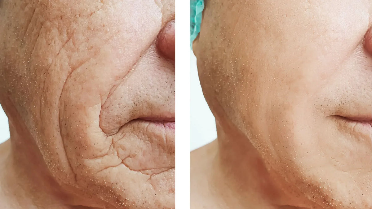 Before and after picture showing wrinkles before marine collagen peptides and wrinkle free after marine collagen peptides